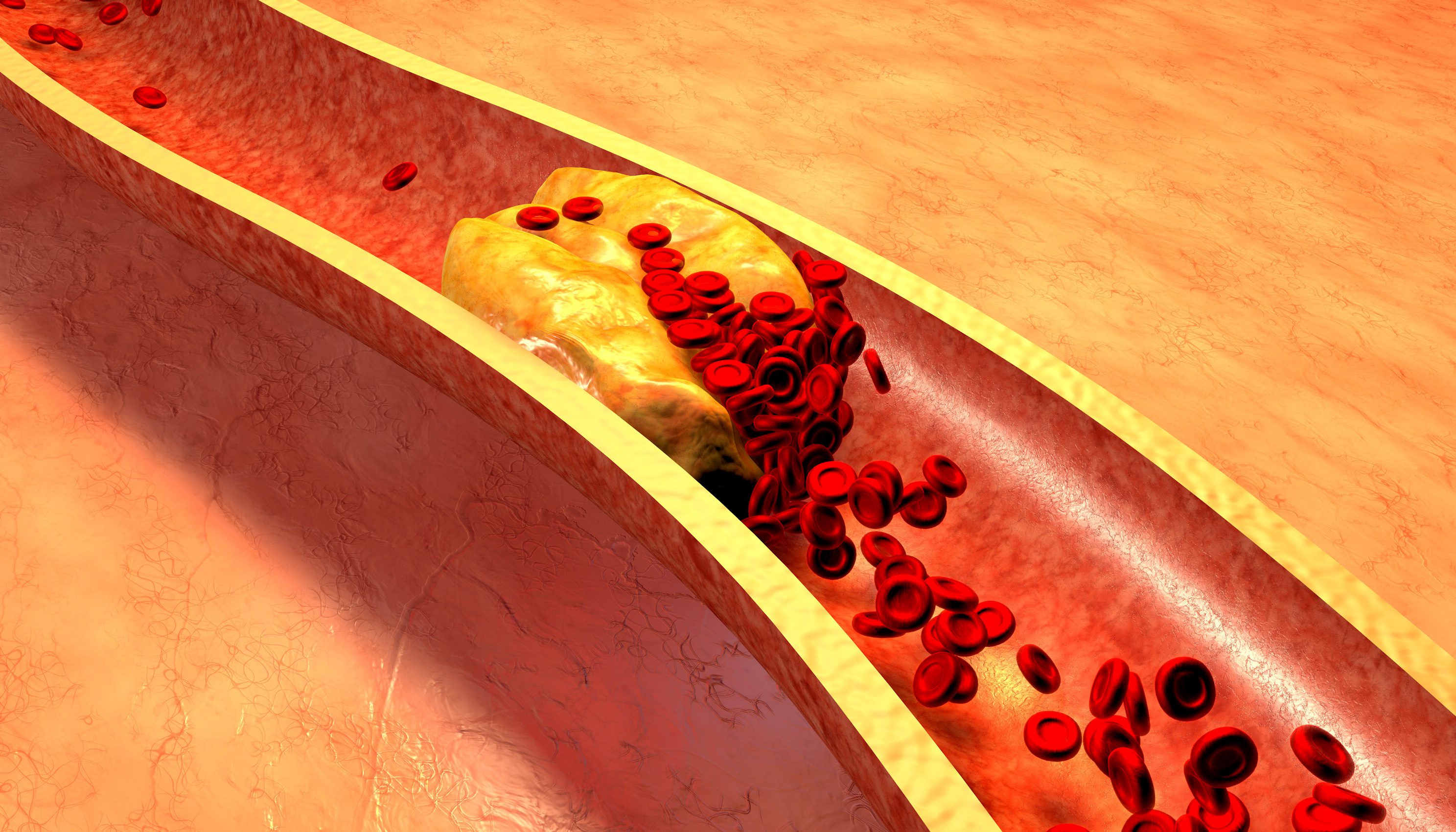 Build-up of fatty material in the arteries can cause them to narrow or block, in a condition known as atherosclerosis (Source : AdobeStock_79614760)